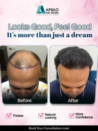 Hair Transplant