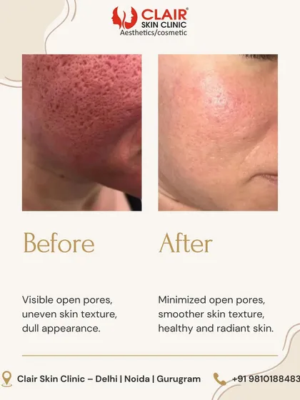 See the remarkable difference in skin texture. This client was concerned with visible open pores and a dull complexion. Our tailored treatment plan resulted in significantly minimized pores, a smoother surface, and a healthy, radiant finish.