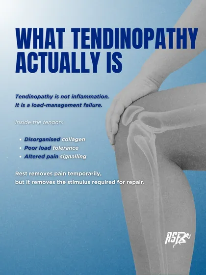 This infographic defines what tendinopathy actually is: a load-management failure characterized by disorganized collagen and poor load tolerance. Rest removes the stimulus required for repair, making it an ineffective long-term strategy.