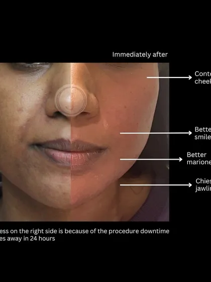 This is a great example of what's possible with a personalized facial contouring plan. You can see how we achieved more contoured cheeks, softened smile lines, and a chiseled jawline. The temporary redness you see fades within 24 hours.
