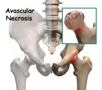 Avascular Necrosis (AVN) is a condition where bone tissue dies due to a lack of blood supply. Physiotherapy plays a crucial role in managing pain, improving mobility, and helping with recovery.