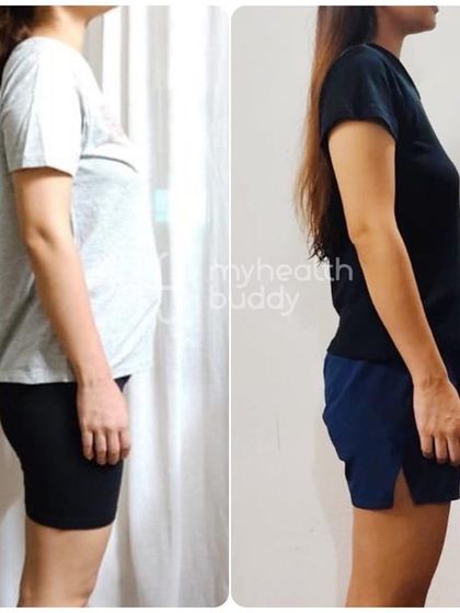 A side view comparison of the client who healed her Diastasis Recti. This shows the power of corrective exercise.