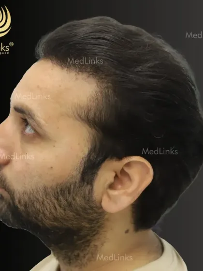 The final result from the side, demonstrating how the new hairline seamlessly integrates with the patient's existing hair.