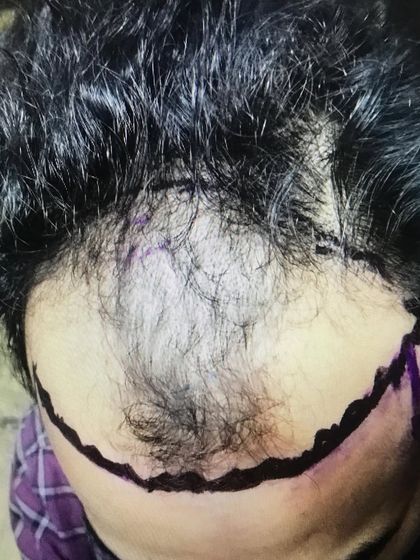 This is the 'before' stage of a client with advanced hair loss. The hairline is marked to create a natural and age appropriate frame for the face before the transplant procedure begins.