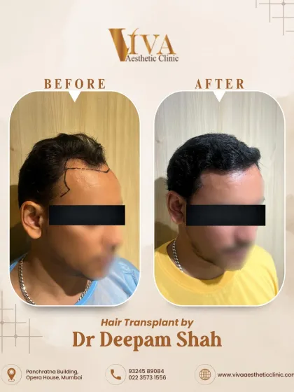 A look at the same patient from the left side. The angle and flow of the transplanted hair are designed to match the patient's original growth pattern, making the result completely undetectable.