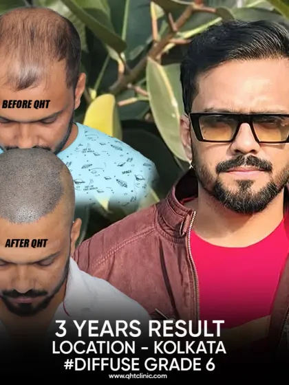 Our results are built to last. This patient's photo was taken 3 years after his surgery for Grade 6 baldness. With 5500 grafts, his hair is as dense and natural as ever, proving the permanence of our QHT Advanced FUE technique.