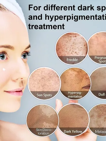 A chart showing the various forms of dark spots and hyperpigmentation I treat. From freckles to melasma, each requires a unique, scientifically-backed approach for optimal results.