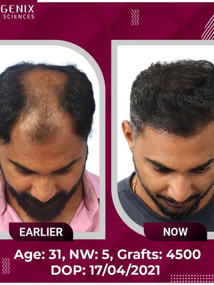 This 31-year-old patient's journey from Grade 5 hair loss to happiness with 4500 grafts.