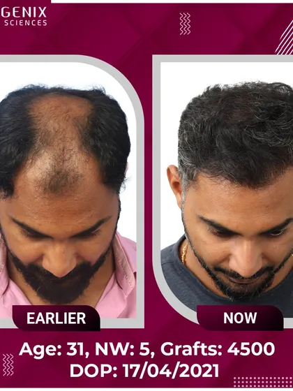 This 31-year-old patient's journey from Grade 5 hair loss to happiness with 4500 grafts.
