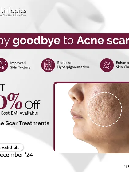 Don't let acne scars affect your confidence. I offer advanced treatments that improve skin texture, reduce hyperpigmentation, and enhance overall skin clarity. Take advantage of our special offer to start your journey.