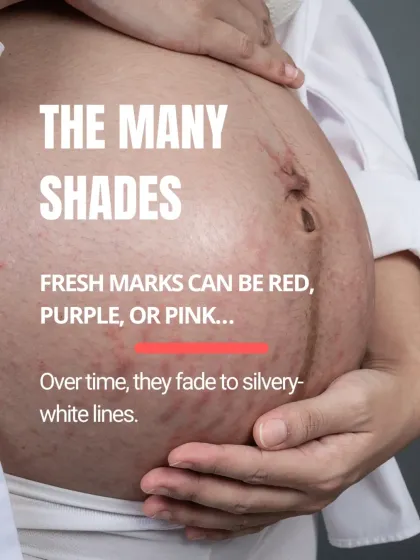 Stretch marks have many shades. Fresh marks can appear red, purple, or pink. Over time, as the inflammation subsides and they heal, they typically fade to silvery-white lines.