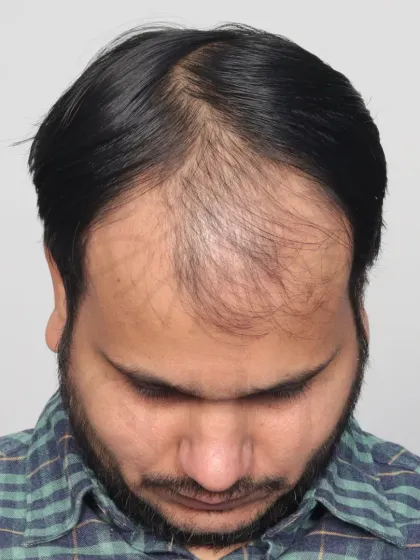 This Norwood Grade 4A patient's 14-month transformation after a single session with 4000 grafts. We restored his hairline and frontal region for a fuller, more confident look.