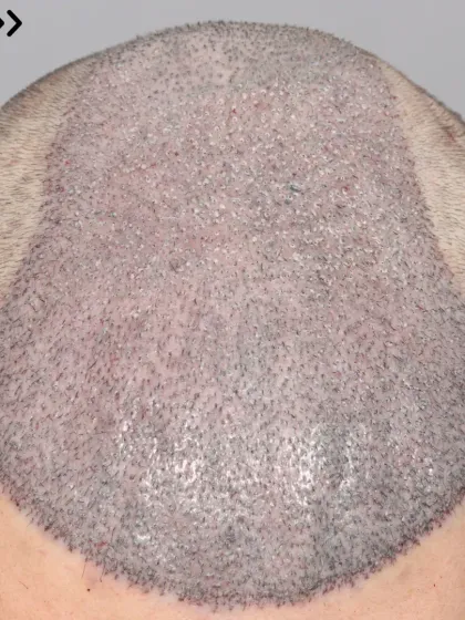 Another repair case for a Norwood Grade 6 patient. We used 5000 grafts to correct the previous work and provide a natural, dense result.