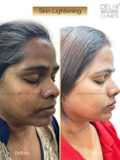 This client achieved a visibly brighter and more even skin tone with our advanced skin lightening treatment, which is designed to be safe and effective.