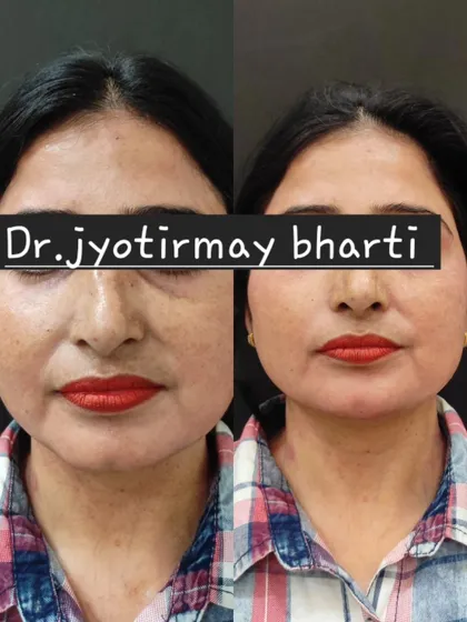Another example of how fillers can rejuvenate the face. In this before and after, you can see how restoring volume to the cheeks has lifted the lower face and reduced the appearance of nasolabial folds.