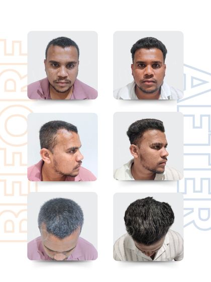 This multi-angle view shows Siddhant Gaikwad's complete transformation. The 2,000 grafts were strategically placed to create a natural-looking hairline and add density, resulting in a balanced and youthful appearance.