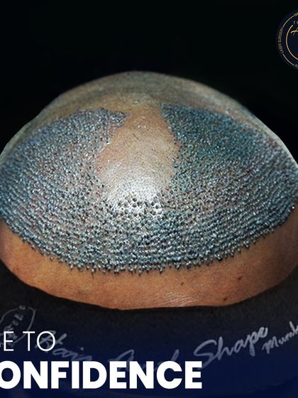 This is where science meets style. A detailed view of newly implanted hair follicles, showcasing the meticulous process of high-density hair restoration.