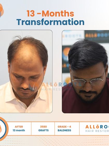 This 13-month transformation of a Grade 4 baldness case was achieved with 3500 grafts. Notice the natural density and the restored hairline from all angles, including a close-up view of the new hair growth.