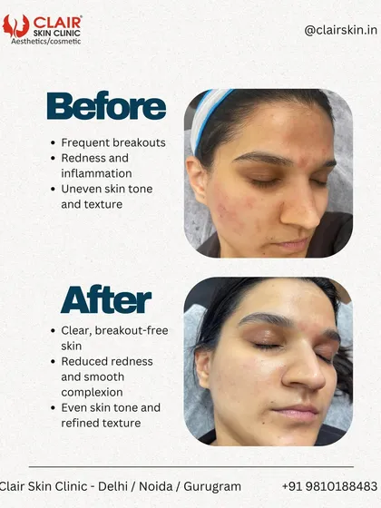 This is the journey from frequent breakouts and inflammation to clear, calm, and balanced skin. Our targeted treatments work to reduce redness, smooth texture, and prevent future breakouts for long-term confidence.