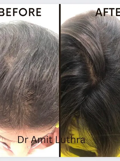 This before and after demonstrates a significant improvement in hair density and volume. My hair restoration treatments are designed to combat thinning and stimulate new growth for fuller, healthier hair.
