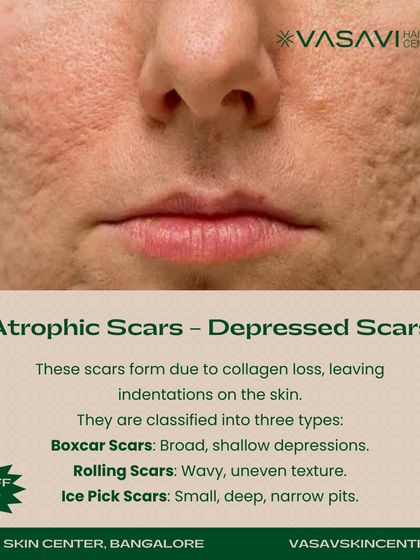 Sree Vasavi - Acne & Scar Treatment A Guide to Acne Scars photo 4