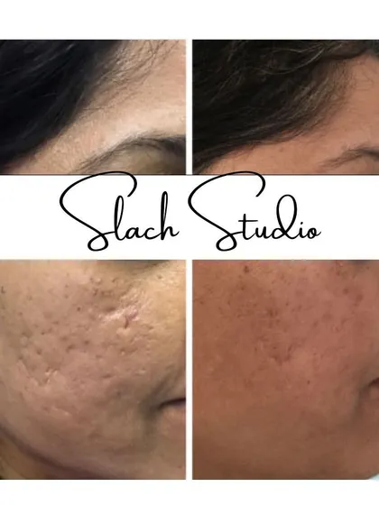 This result highlights the treatment's effectiveness on atrophic, or pitted, acne scars, showing a much smoother skin surface after the session.