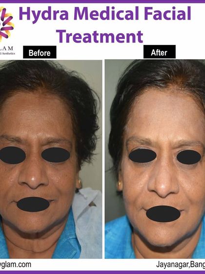 The 'after' photo shows the powerful effects of a Hydra Medical Facial on mature skin. The treatment improved hydration, reduced the appearance of fine lines, and gave the skin a healthier, more luminous quality.