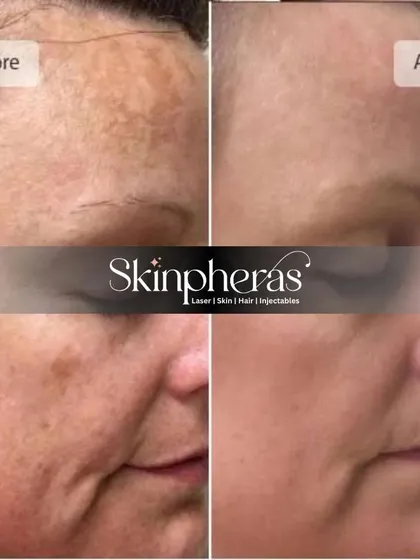 A powerful before and after image showcasing the results of our pigmentation treatment. We effectively reduced dark spots and uneven skin tone, revealing a clearer and more uniform complexion.