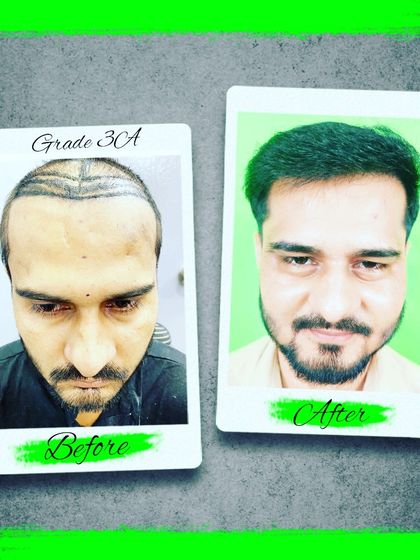 Another successful transformation for a patient with Grade 3A baldness. The before and after images clearly demonstrate the high quality, dense results we achieve.