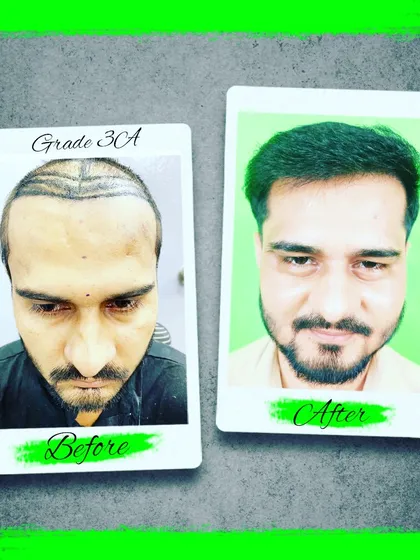 Another successful transformation for a patient with Grade 3A baldness. The before and after images clearly demonstrate the high quality, dense results we achieve.