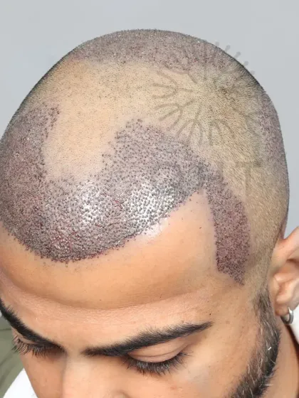 A fresh after-surgery look for a Norwood Grade 5 case. 5500 grafts were used to restore the hairline, frontal region, and crown.