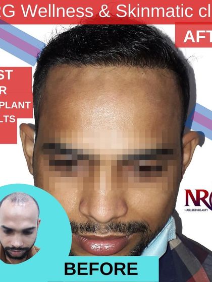 This is what a successful hair transplant looks like. The client's 'before' photo shows significant balding, while the 'after' photo displays a complete and dense hair restoration.