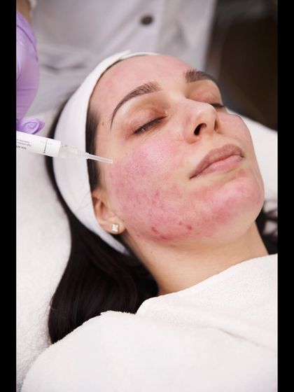 This image shows a patient immediately after a PRP session. The redness is temporary and a sign that the skin's healing and rejuvenation process has begun, leading to a beautiful glow in the following days.