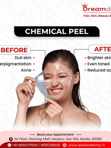 See the clear difference a chemical peel can make. This before-and-after graphic illustrates how the treatment transforms dull, hyperpigmented, and acne-prone skin into a brighter, even-toned, and clearer complexion.