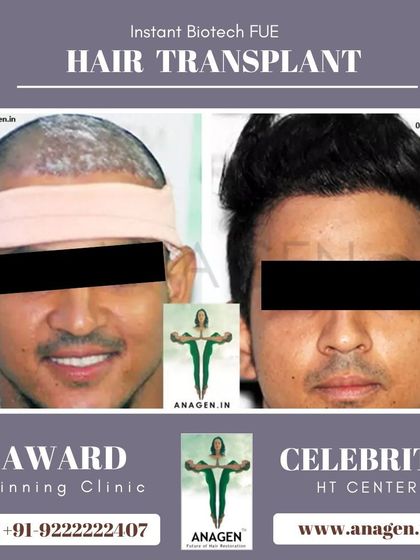 This patient's journey from post op to a full head of hair demonstrates the effectiveness of our Instant Biotech FUE technique.