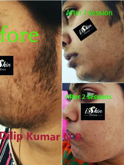 This series demonstrates the effectiveness of our laser hair reduction for the face. You can see the progressive results, from the initial state to significant hair removal after just one and then two sessions, leading to much smoother skin.