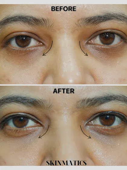 Tired-looking eyes are a common concern. Here, we used under-eye fillers to correct hollowness in the tear trough area, resulting in a smoother, brighter, and more rested appearance.
