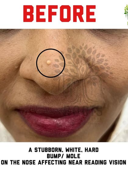 A "before" photo of another client who had a stubborn, hard white mole on her nose that even laser treatment couldn't permanently remove.