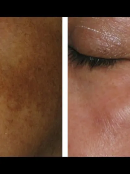 Treating pigmentation around the delicate eye area requires expertise. This result shows a visible reduction in periorbital hyperpigmentation, achieved with specialized peels and laser treatments.