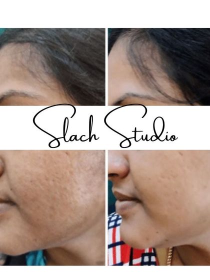 A clear example of how the treatment can improve texture from open pores and scarring, resulting in smoother skin.