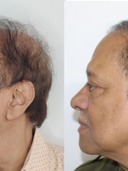 Another side profile, highlighting the comprehensive restoration from the front hairline to the crown.