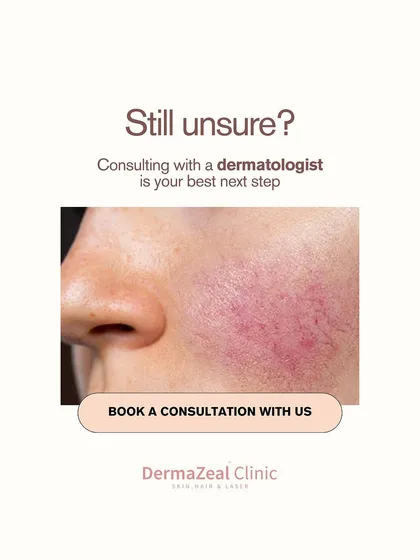 If you're still unsure whether you have Rosacea or another condition, consulting with a dermatologist is your best next step. A proper diagnosis is key to effective management.