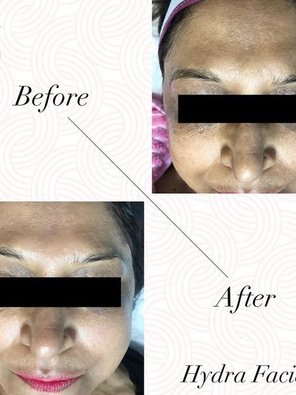 This before and after shot clearly shows how a HydraFacial brightens dull skin and reduces fine lines for a more youthful look in a single session.