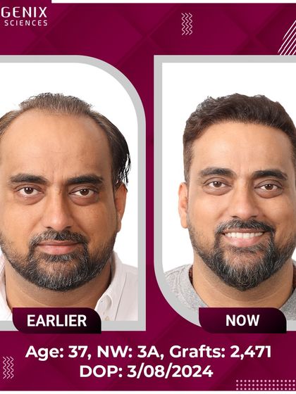 The confident smile of this 37-year-old after his 2471-graft procedure says it all.