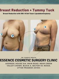 Breast Surgery
