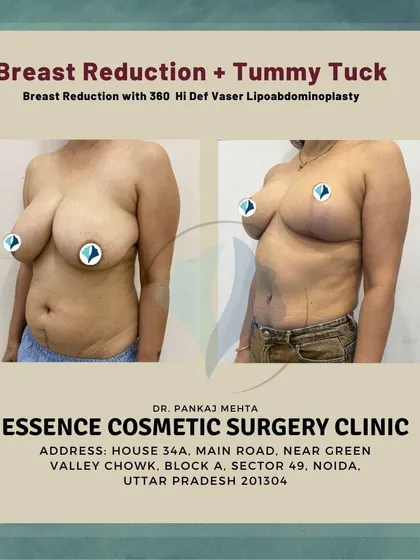 This image shows the transformative result of a Mommy Makeover, combining a breast reduction with a 360 Hi-Def Vaser Lipoabdominoplasty. The 'after' photo displays lifted, more proportionate breasts and a significantly flatter, more toned abdomen.