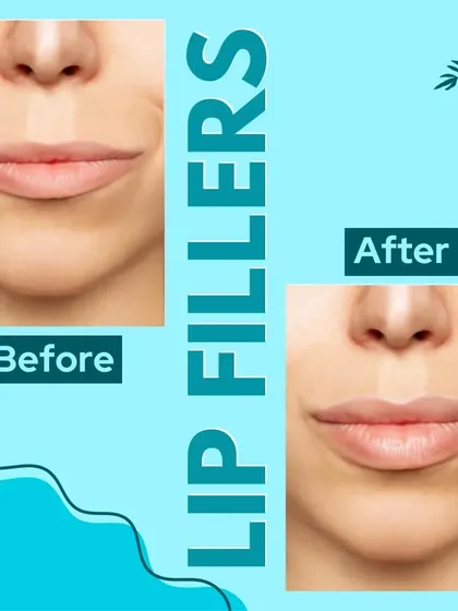See the subtle yet impactful transformation possible with our lip fillers. We focus on creating natural-looking volume and definition, enhancing your features while maintaining facial harmony.