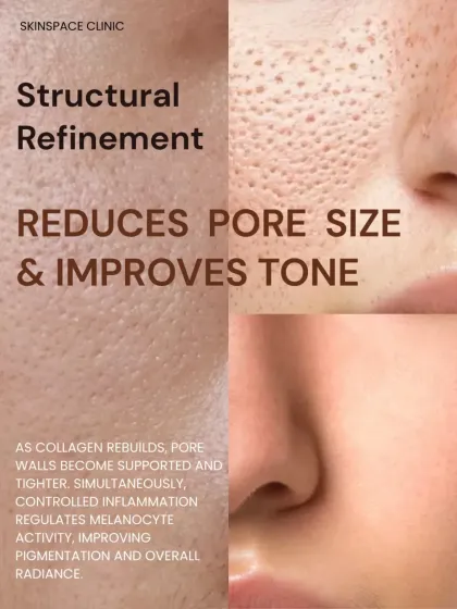 One of the key benefits of microneedling is structural refinement. As collagen rebuilds, pore walls become more supported and appear tighter. The treatment also helps regulate melanocyte activity, improving pigmentation and overall radiance.