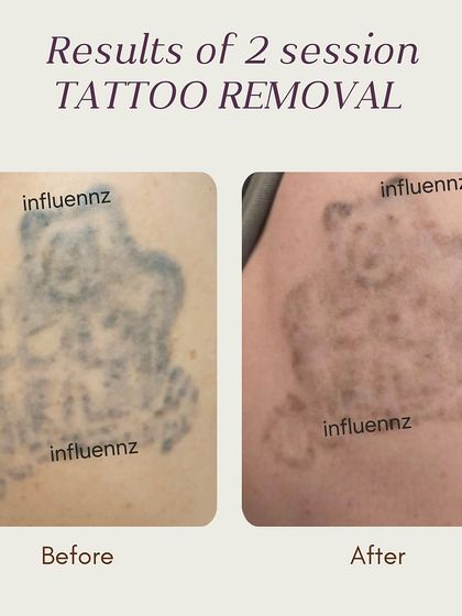 This before and after image shows the progress of a large tattoo removal after just two sessions. You can see the ink has broken up and faded considerably. This demonstrates how the process works gradually to clear the tattoo.