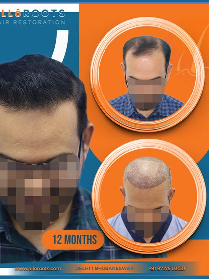 A 12-month transformation showing the before, post-op, and final result. This collage format gives a quick yet comprehensive overview of the patient's successful journey.